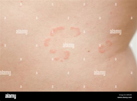 mild psoriasis on skin on side of abdomen Stock Photo - Alamy