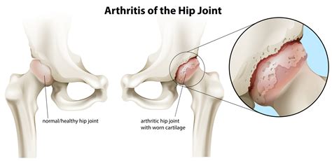 Hip Pain Treatment - Chiropractor in Nashville — Chiropractor Nashville ...