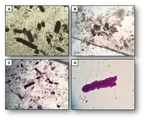 Urine Sediment of the Month: Granular & "Muddy Brown" Casts - Renal ...