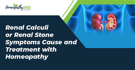 Renal Calculi or Renal Stone Symptoms Cause and Treatment with Homeopathy