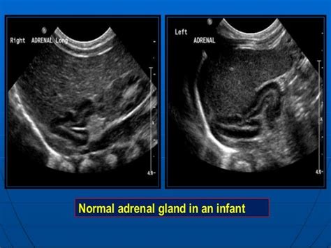 Normal adrenal gland | Medical ultrasound, Ultrasound, Ultrasound ...