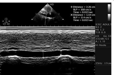 Table 3 from Assessment of inferior vena cava diameter by echocardiography in normal Indian ...