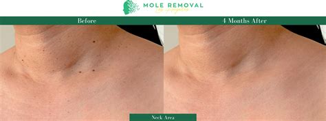 Skin Tag Removal Los Angeles | Remove Unsightly Skin Tag