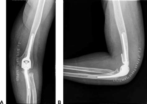 Results of Total Elbow Arthroplasty in Patients Less Than 50 Years Old ...