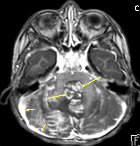 Medulloblastoma - MRI Online