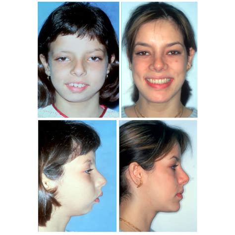 Before and After Photos Maxillofacial Surgery - Larry M. Wolford, DMD