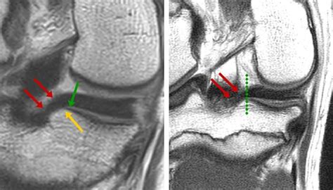 Meniscal Root Tears: Posterior Horn Meniscus Part 2 - Radedasia