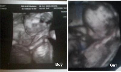 Twins - 3D Ultrasound