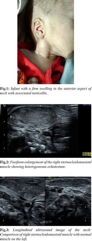 Fibromatosis colli or Pseudotumour of Sternocleidomastoid