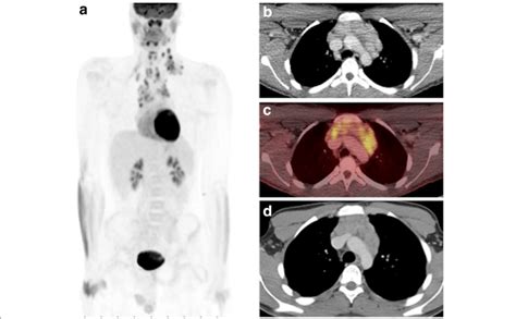 Contrast enhanced low dose attenuation correction CT from PET/CT exam ...