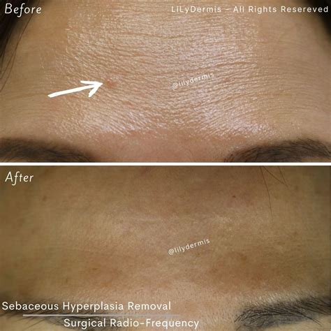 Sebaceous Hyperplasia Removal | LiLyDermis | Calgary