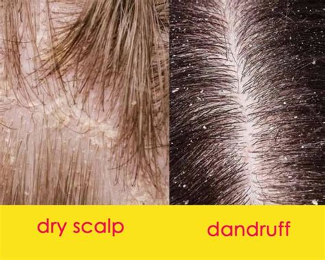 Dandruff vs. Dry Scalp, Can You Tell The Difference? - Hairstyles Weekly