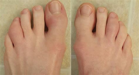 Case Report: A Psoriatic Arthritis Patient with Dactylitis & Enthesitis ...