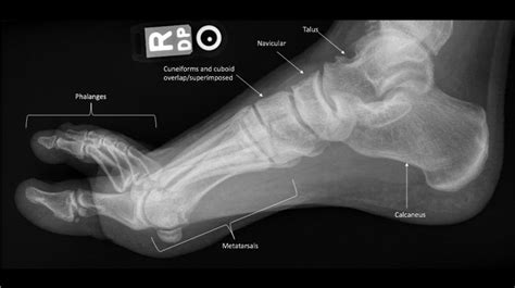 [Figure, Lateral view of the foot. Contributed by Douglas Byerly, MD PhD] - StatPearls - NCBI ...