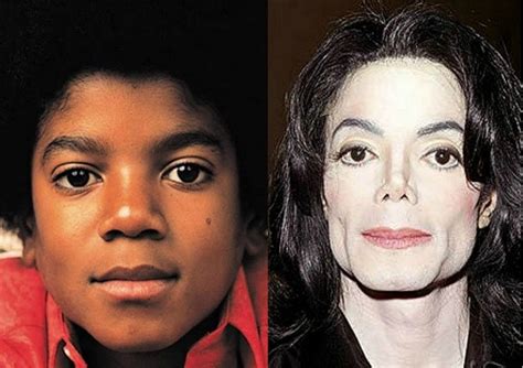 How Michael Jackson struggled with vitiligo and turned white - Face2Face Africa