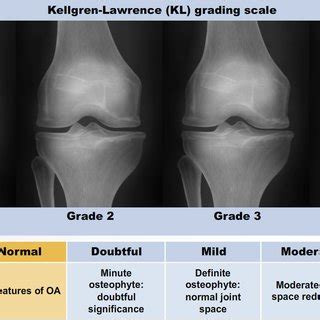 3: The Kellgren and Lawrence grading system to assess the severity of ...