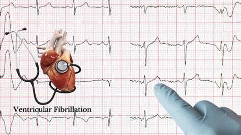 Ventricular Fibrillation Treatment