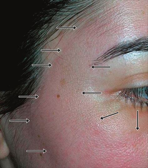 Localized Contact Urticaria Caused by Lidocaine/Tetracaine Peel | Allergy and Clinical ...