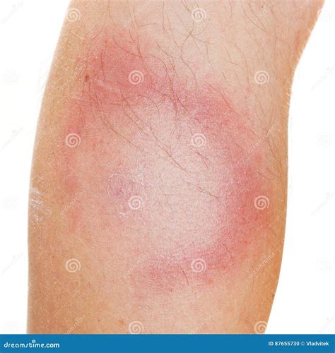 Erythema Migrans Rash. Stock Photo | CartoonDealer.com #87655506