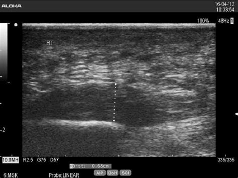 Plantar Fasciitis Ultrasound-Guided Injection Procedures | ubicaciondepersonas.cdmx.gob.mx