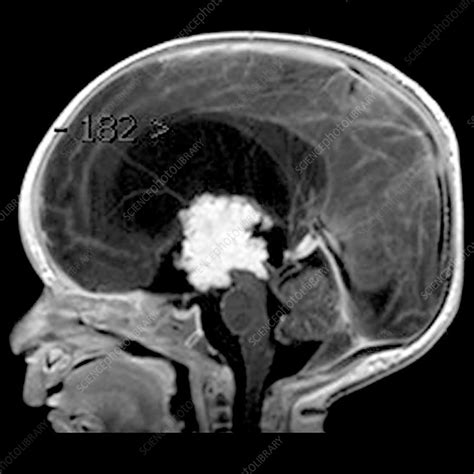 MRI Choroid Plexus Papilloma in Infant - Stock Image - C043/3061 - Science Photo Library