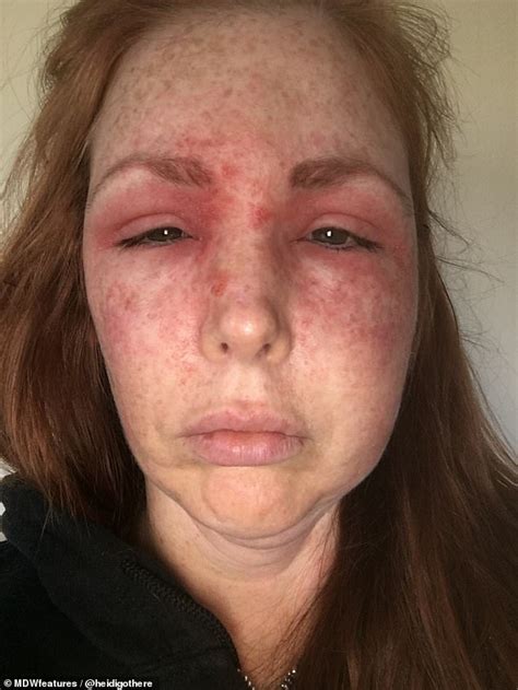 Woman, 42, wakes up with a BLACK EYE and swollen face after being ...