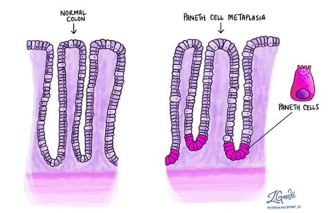 Chronic active colitis | MyPathologyReport.ca