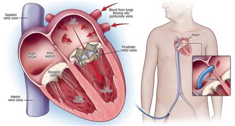 Best Heart Valve Replacement Surgery Cost In India 2023-Medicare Spots