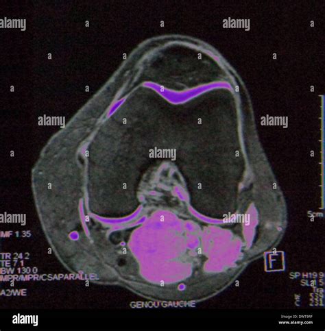 Musculus biceps femoris hi-res stock photography and images - Alamy