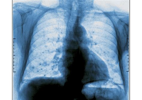 Metastatic UTUC Has Poor Prognosis, Low Chemosensitivity - Renal and ...