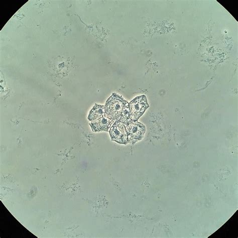 Squamous epithelial cells (Phase contrast x400) #urinarysediment #urine ...