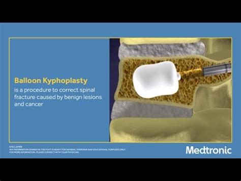 Balloon Kyphoplasty procedure | Medtronic India - YouTube