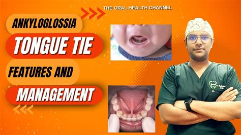 Dr Rudra Mohan | Tongue Tie (ANKYLOGLOSSIA) at a glance | Symptoms, Features and Management ...