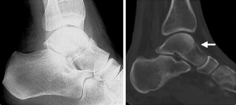 Defining Talar Head and Neck Pathology: The Malvern Classification ...