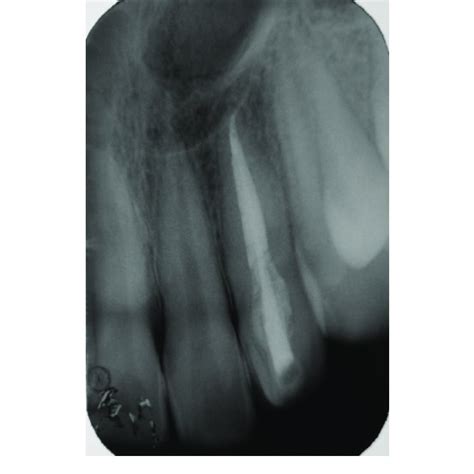 Intra oral periapical radiograph at 2 years follow up, radiographic... | Download Scientific Diagram