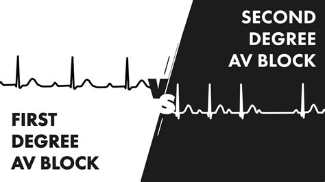 First vs Second Degree Heart Block - EKG Rhythm Interpretation - YouTube