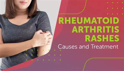 Rheumatoid Arthritis Rashes: Causes and Treatment | myRAteam