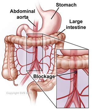 emDOCs.net – Emergency Medicine EducationMesenteric Ischemia: A Power Review - emDOCs.net ...