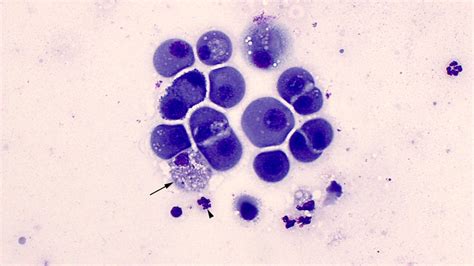 Pericardial fluid | eClinpath