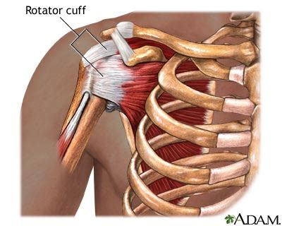 synch-ro-ni-zing: torn rotator cuff