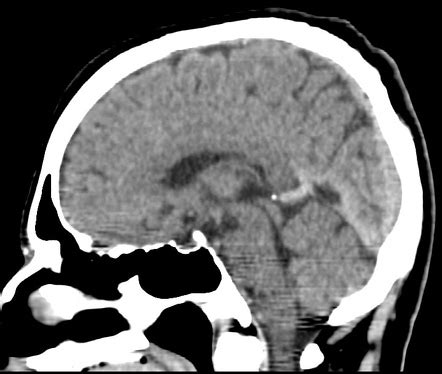 Normal brain CT - 60-year-old | Image | Radiopaedia.org