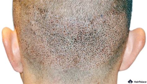 Hair Transplant Holes and Trypophobia | Causes and Treatments