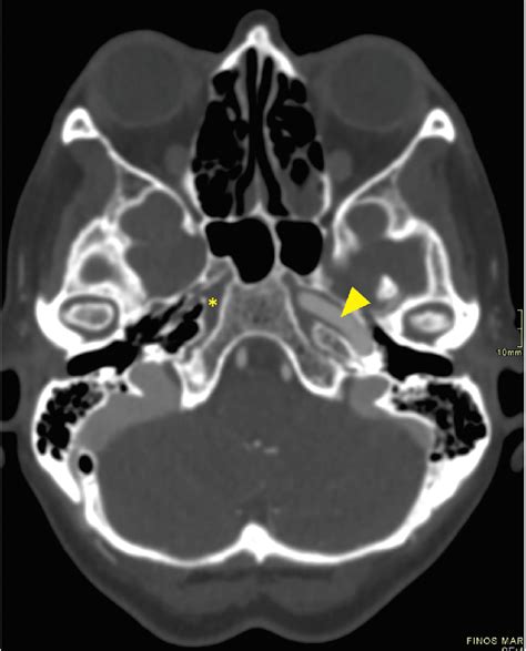 CTA axial image of the skull base showing normal left carotid canal ...