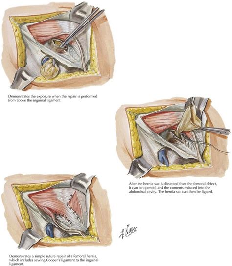 Femoral Hernia Anatomy