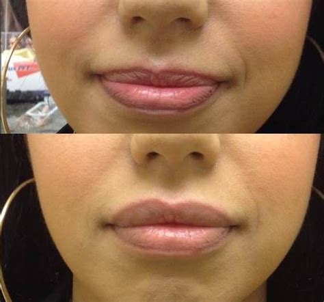 Lip augmentation with restylane | Lip augmentation, Restylane, Dermal ...