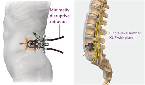 Extreme Lateral Interbody Fusion (XLIF) | Manhattan Spine Consultants