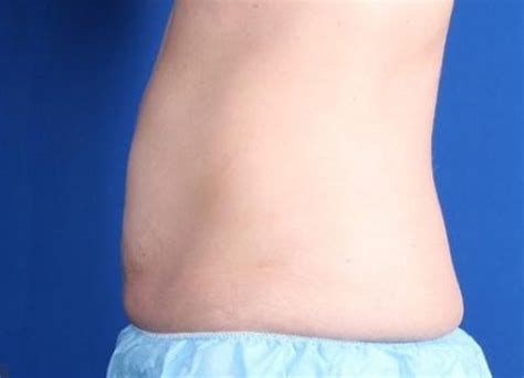 Contour Dermatology coolsculpting-abdomen-side-after-1 | Contour ...