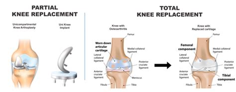 Guide To Getting A Knee Replacement in Singapore (2020) - GaiaGuides.com