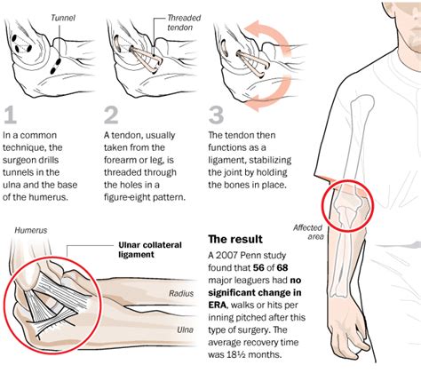 Tommy John Surgery – Coffee Spoons