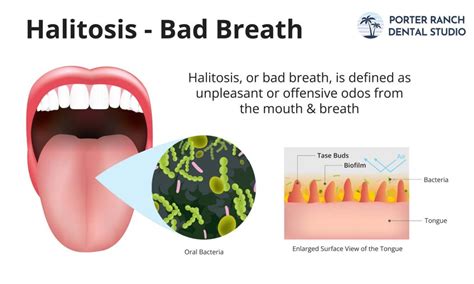 What is Halitosis & What Causes Halitosis? - Porter Ranch Dental Studio